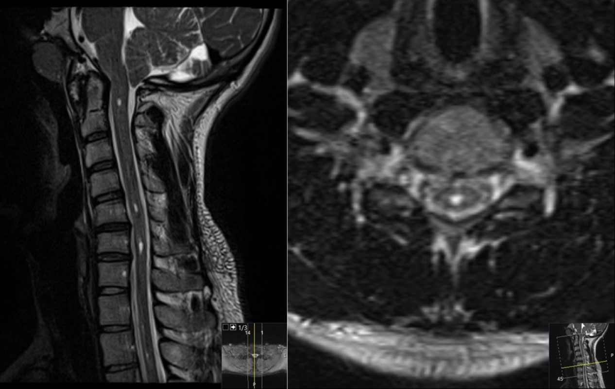 Chiari Malformation
