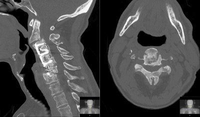 Cervical stenosis with myelopathy