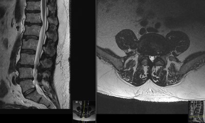Sacroiliac joint (SIJ) dysfunction
