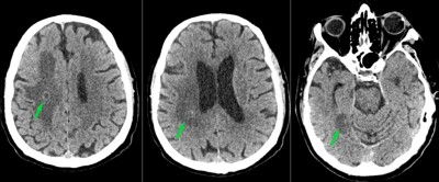 Craniotomy for Brain Abscess